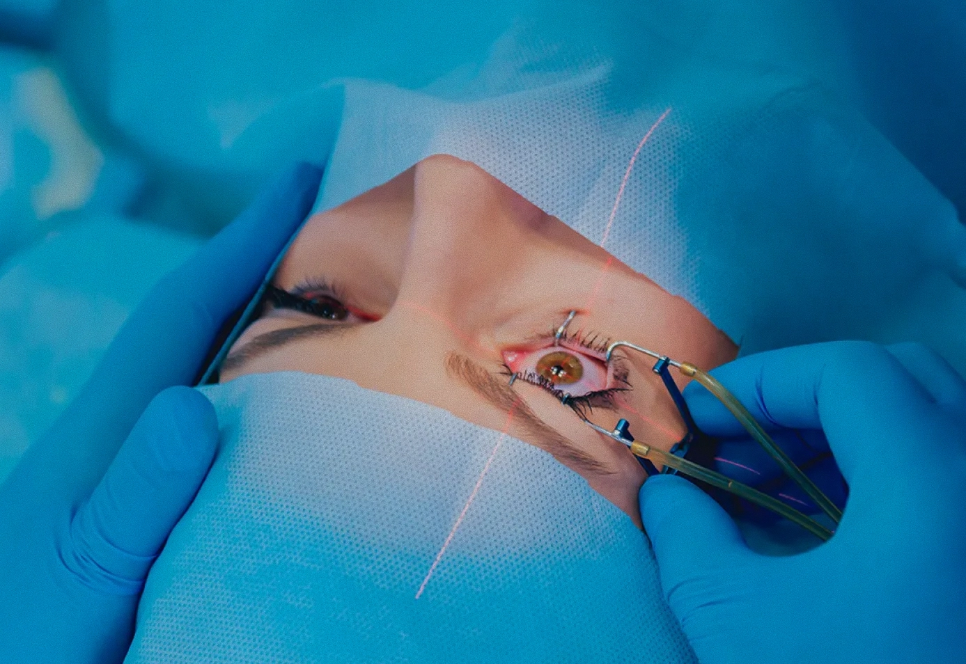 Cirurgia Refrativa